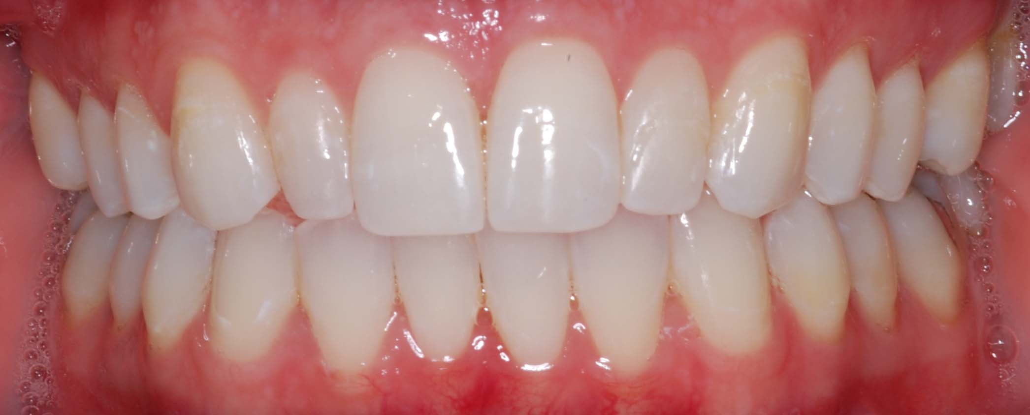 Invisalign After